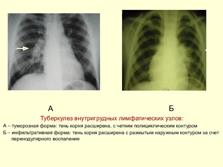 А Б Туберкулез внутригрудных лимфатических узлов: А – туморозная форма: