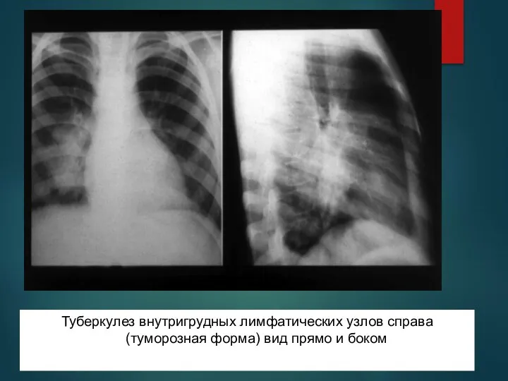 Туберкулез внутригрудных лимфатических узлов справа(туморозная форма) вид прямо и боком