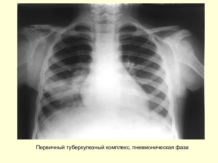 Первичный туберкулезный комплекс, пневмоническая фаза