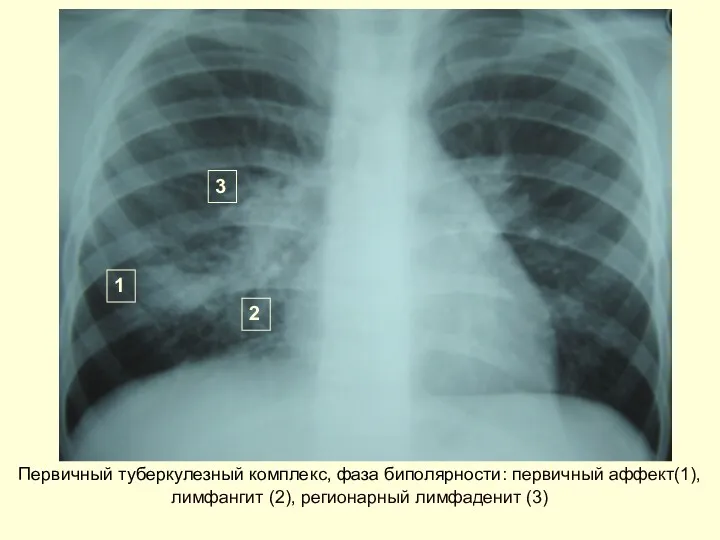 Первичный туберкулезный комплекс, фаза биполярности: первичный аффект(1), лимфангит (2), регионарный лимфаденит (3) 1 2 3
