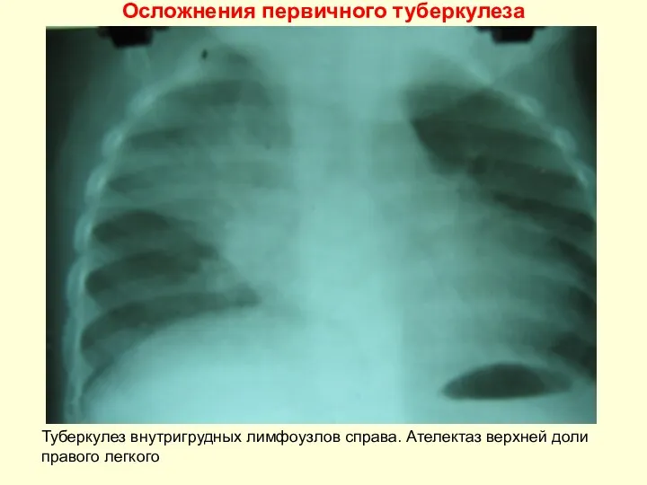 Осложнения первичного туберкулеза Туберкулез внутригрудных лимфоузлов справа. Ателектаз верхней доли правого легкого