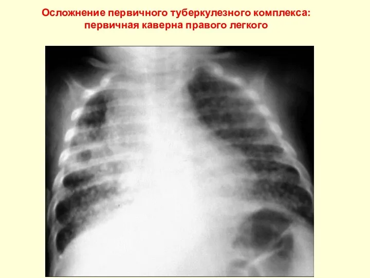 Осложнение первичного туберкулезного комплекса: первичная каверна правого легкого