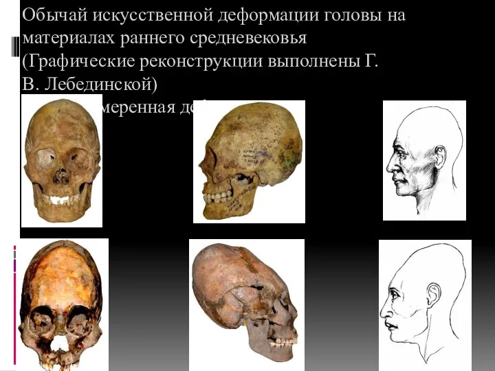 Обычай искусственной деформации головы на материалах раннего средневековья (Графические реконструкции выполнены Г.В. Лебединской) 1. преднамеренная деформация