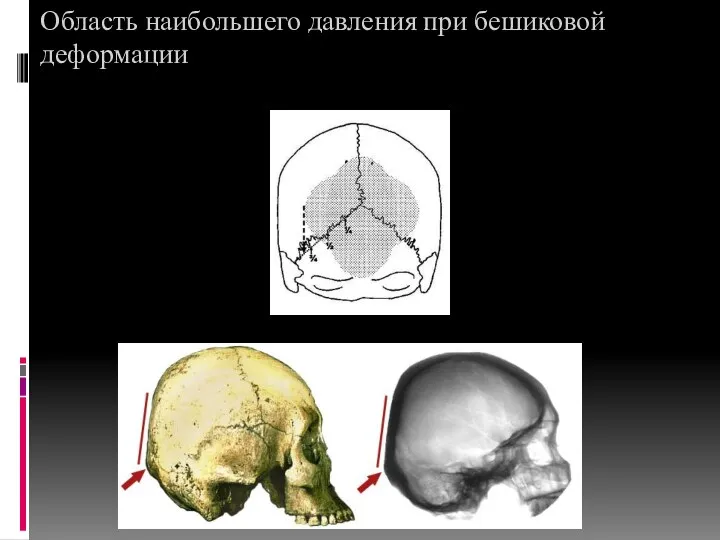 Область наибольшего давления при бешиковой деформации 1