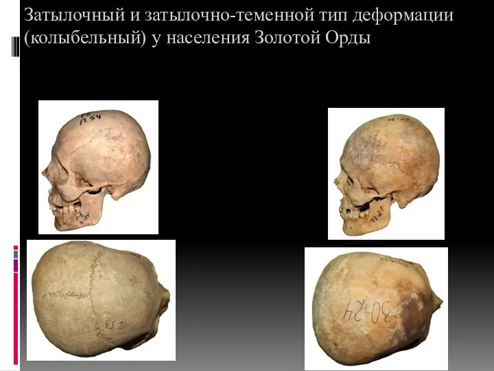 Затылочный и затылочно-теменной тип деформации (колыбельный) у населения Золотой Орды