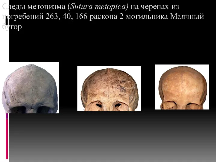 Следы метопизма (Sutura metopica) на черепах из погребений 263, 40, 166 раскопа 2 могильника Маячный бугор