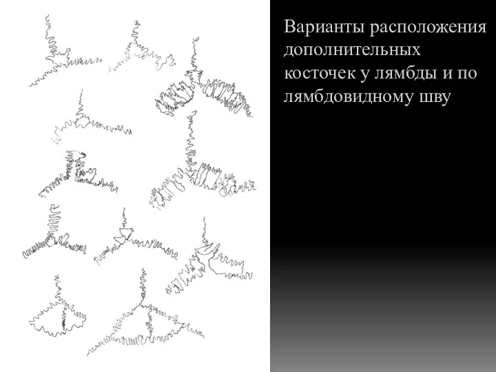 Варианты расположения дополнительных косточек у лямбды и по лямбдовидному шву