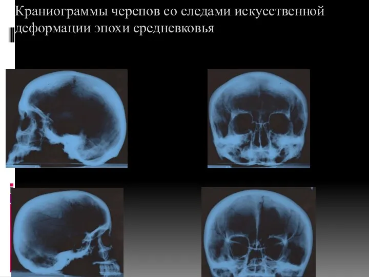 Краниограммы черепов со следами искусственной деформации эпохи средневковья