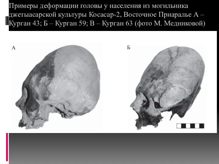 Примеры деформации головы у населения из могильника джетыасарской культуры Косасар-2,