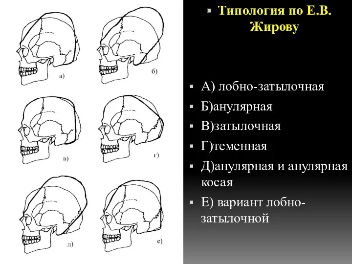 Типология по Е.В.Жирову А) лобно-затылочная Б)анулярная В)затылочная Г)теменная Д)анулярная и анулярная косая Е) вариант лобно-затылочной