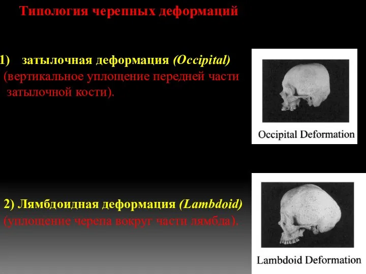 Типология черепных деформаций затылочная деформация (Occipital) (вертикальное уплощение передней части