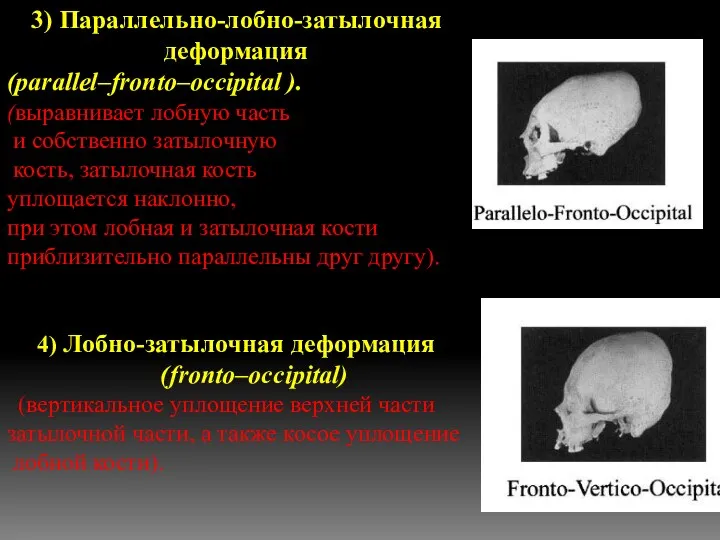 3) Параллельно-лобно-затылочная деформация (parallel–fronto–occipital ). (выравнивает лобную часть и собственно