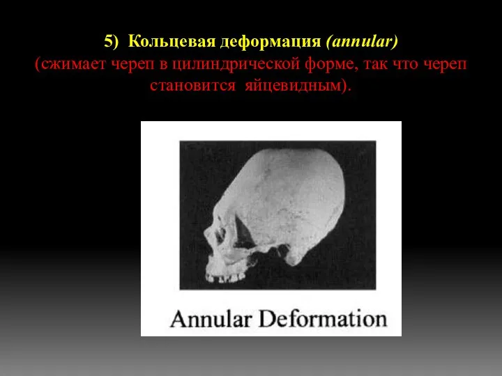 5) Кольцевая деформация (annular) (сжимает череп в цилиндрической форме, так что череп становится яйцевидным).