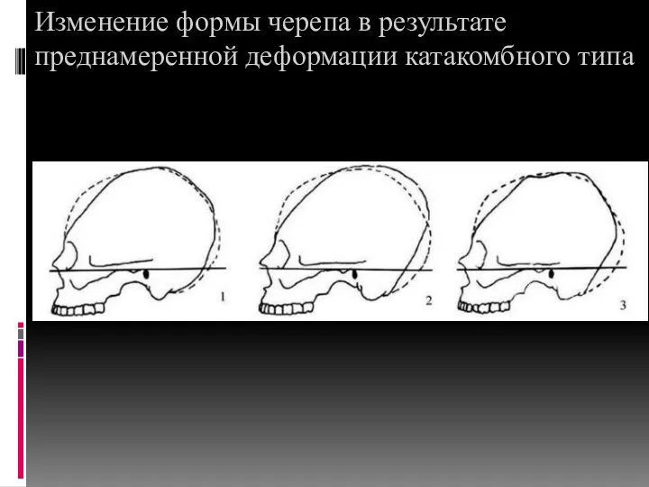 Изменение формы черепа в результате преднамеренной деформации катакомбного типа