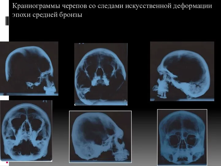 Краниограммы черепов со следами искусственной деформации эпохи средней бронзы 3