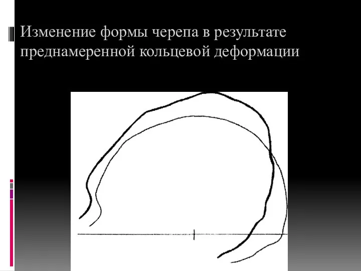 Изменение формы черепа в результате преднамеренной кольцевой деформации