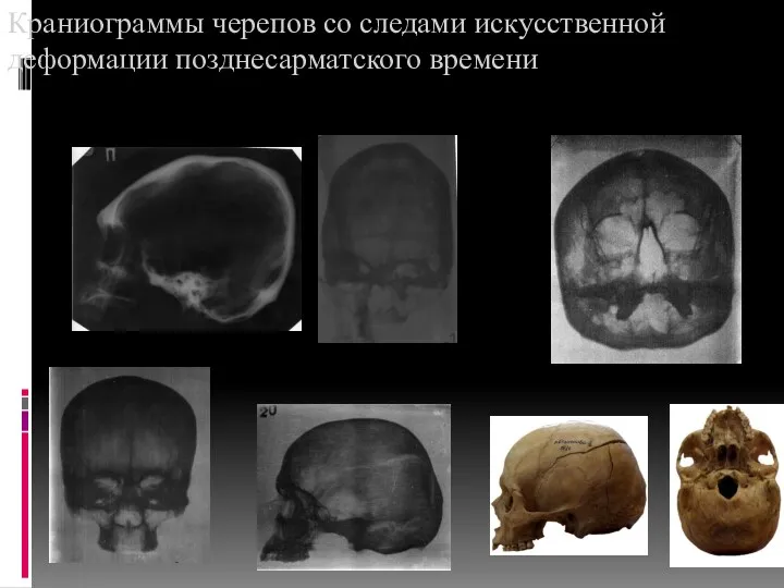 Краниограммы черепов со следами искусственной деформации позднесарматского времени 1 3