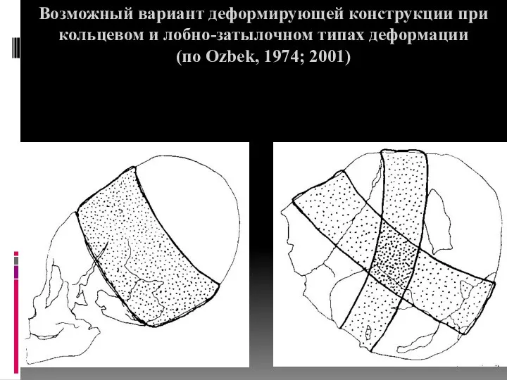Возможный вариант деформирующей конструкции при кольцевом и лобно-затылочном типах деформации (по Ozbek, 1974; 2001) 1
