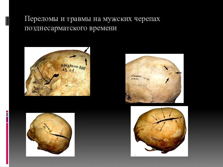 Переломы и травмы на мужских черепах позднесарматского времени 3/1 4/2