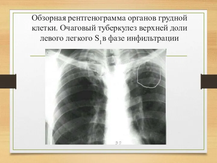 Обзорная рентгенограмма органов грудной клетки. Очаговый туберкулез верхней доли левого легкого S1в фазе инфильтрации