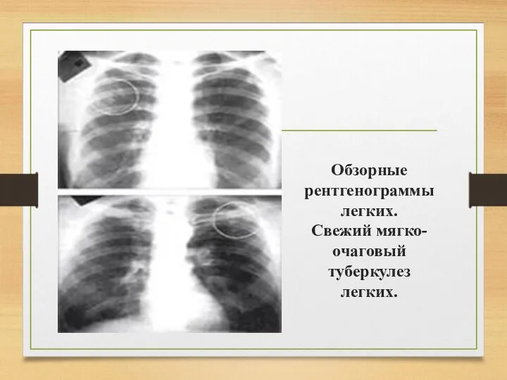 Обзорные рентгенограммы легких. Свежий мягко-очаговый туберкулез легких.