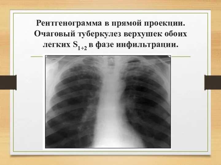 Рентгенограмма в прямой проекции. Очаговый туберкулез верхушек обоих легких S1+2 в фазе инфильтрации.