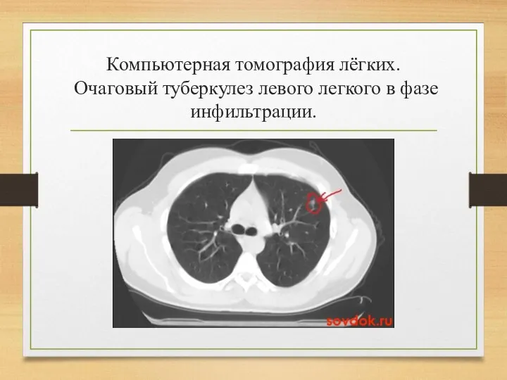 Компьютерная томография лёгких. Очаговый туберкулез левого легкого в фазе инфильтрации.