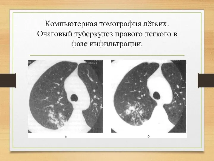 Компьютерная томография лёгких. Очаговый туберкулез правого легкого в фазе инфильтрации.