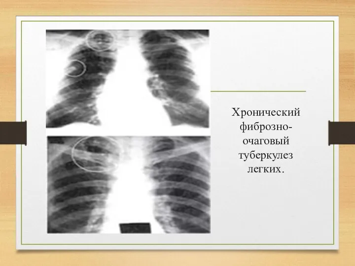 Хронический фиброзно- очаговый туберкулез легких.