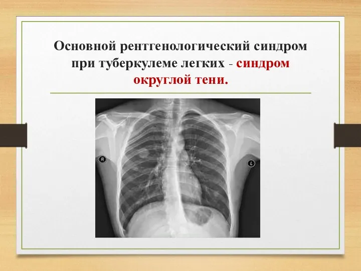 Основной рентгенологический синдром при туберкулеме легких - синдром округлой тени.