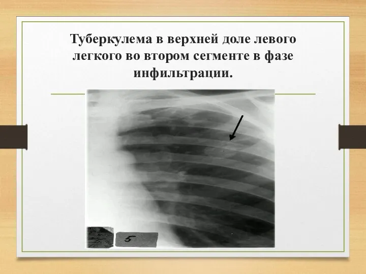 Туберкулема в верхней доле левого легкого во втором сегменте в фазе инфильтрации.