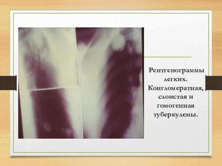 Рентгенограммы легких. Конгломератная, слоистая и гомогенная туберкулемы.