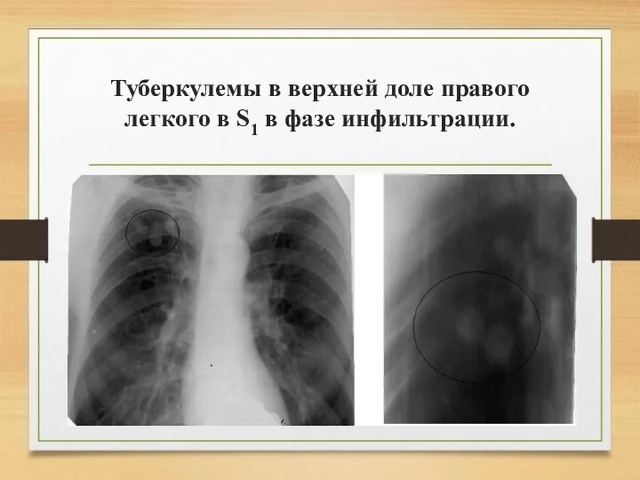 Туберкулемы в верхней доле правого легкого в S1 в фазе инфильтрации.