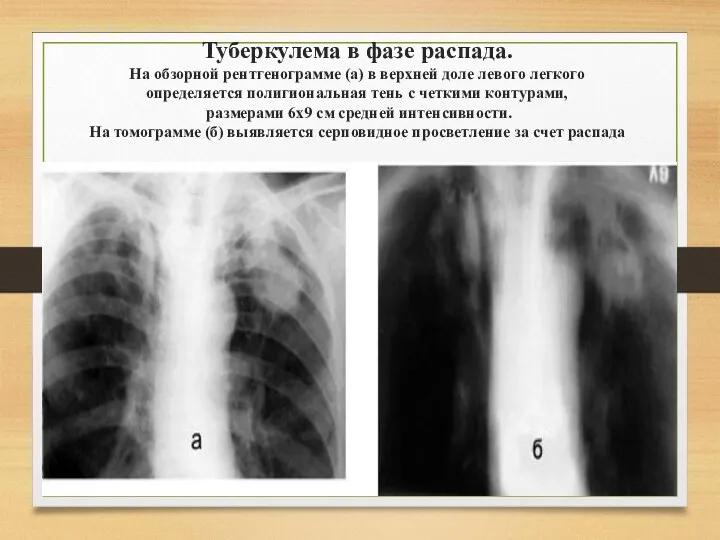Туберкулема в фазе распада. На обзорной рентгенограмме (а) в верхней