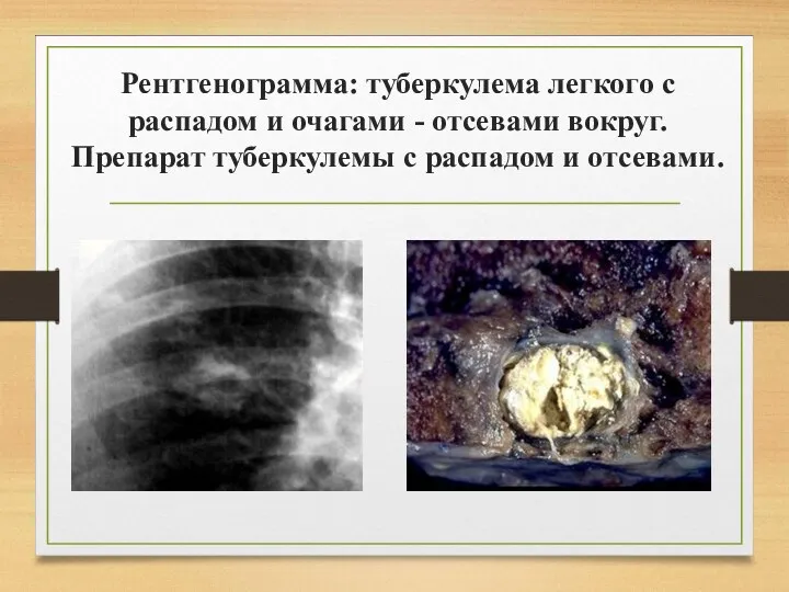 Рентгенограмма: туберкулема легкого с распадом и очагами - отсевами вокруг. Препарат туберкулемы с распадом и отсевами.