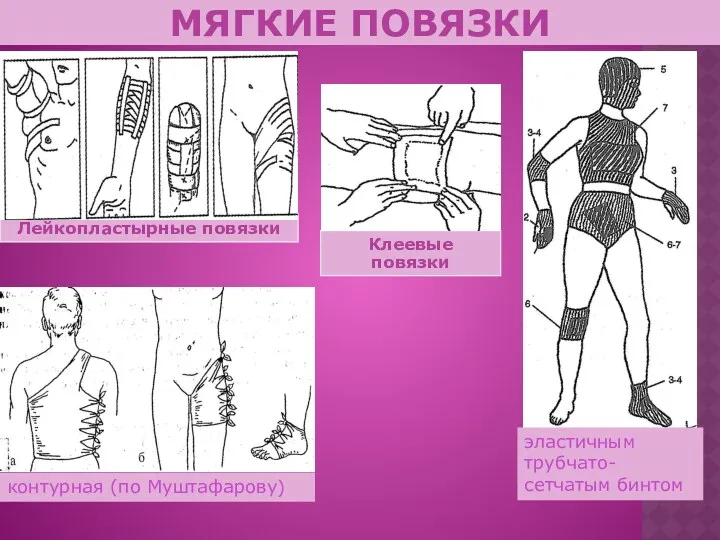 МЯГКИЕ ПОВЯЗКИ Лейкопластырные повязки Клеевые повязки эластичным трубчато-сетчатым бинтом контурная (по Муштафарову)