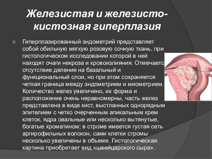 Железистая и железисто-кистозная гиперплазия Гиперплазированный эндометрий представляет собой обильную мягкую