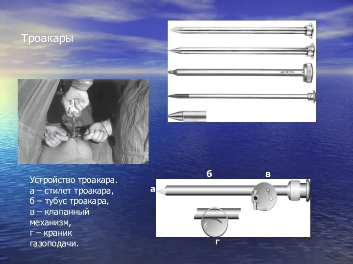 Троакары Устройство троакара. а – стилет троакара, б – тубус