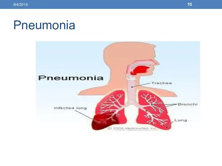 Pneumonia 9/4/2019