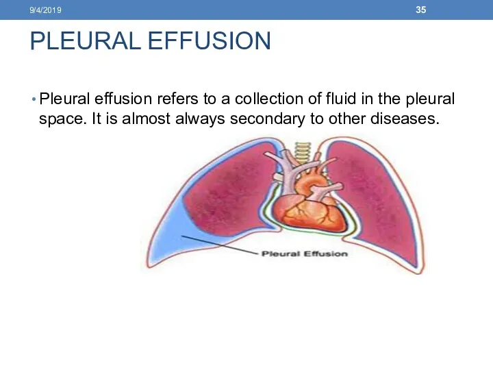 PLEURAL EFFUSION Pleural effusion refers to a collection of fluid in the pleural