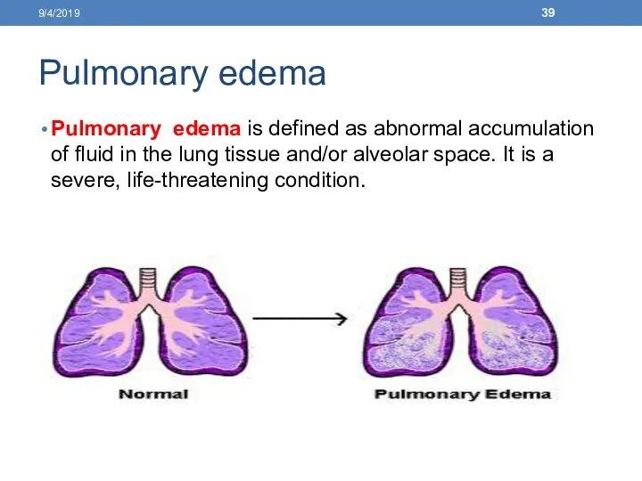 Pulmonary edema Pulmonary edema is defined as abnormal accumulation of fluid in the