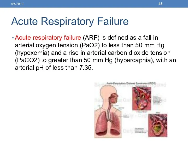 Acute Respiratory Failure Acute respiratory failure (ARF) is defined as a fall in