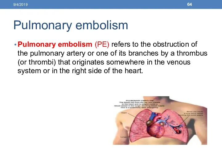 Pulmonary embolism Pulmonary embolism (PE) refers to the obstruction of the pulmonary artery
