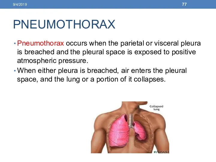 PNEUMOTHORAX Pneumothorax occurs when the parietal or visceral pleura is breached and the