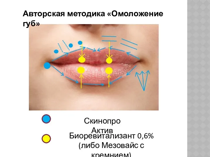 Авторская методика «Омоложение губ» Скинопро Актив Биоревитализант 0,6% (либо Мезовайс с кремнием)