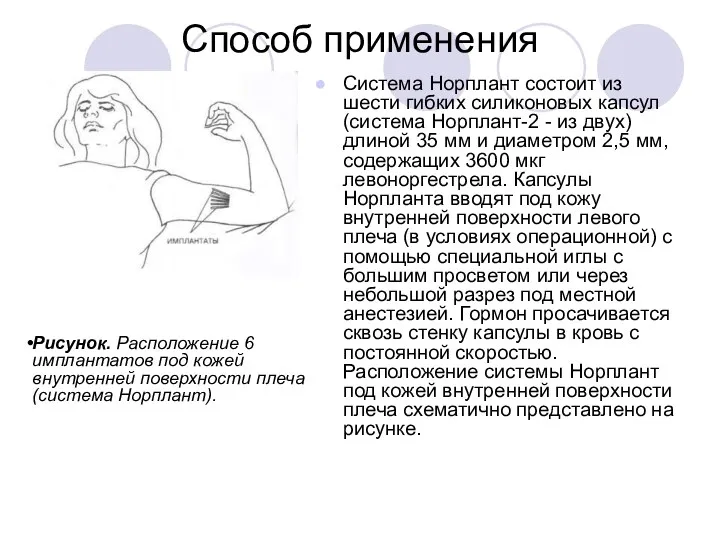 Способ применения Система Норплант состоит из шести гибких силиконовых капсул