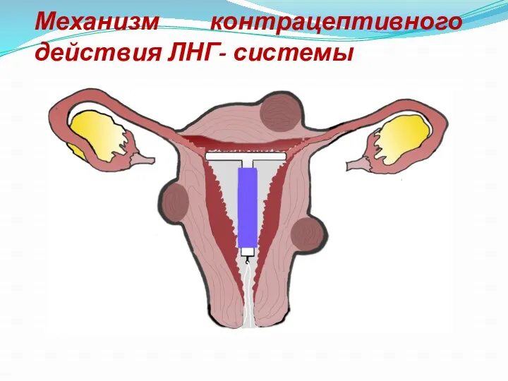 Механизм контрацептивного действия ЛНГ- системы