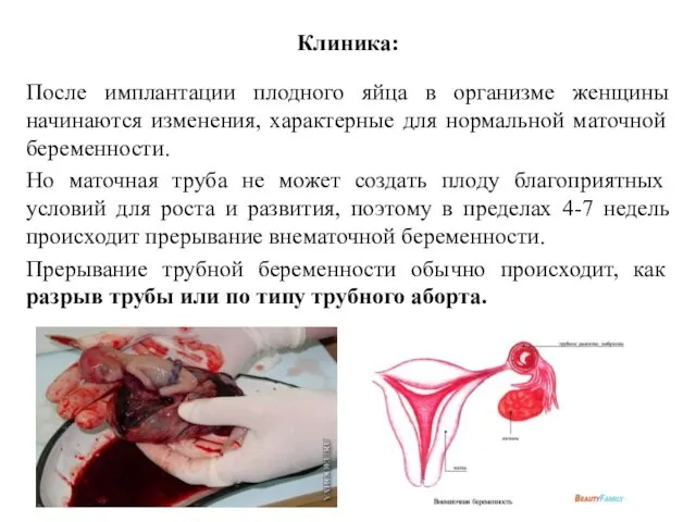 Клиника: После имплантации плодного яйца в организме женщины начинаются изменения, характерные для нормальной
