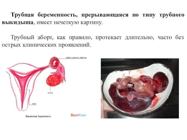 Трубная беременность, прерывающаяся по типу трубного выкидыша, имеет нечеткую картину.