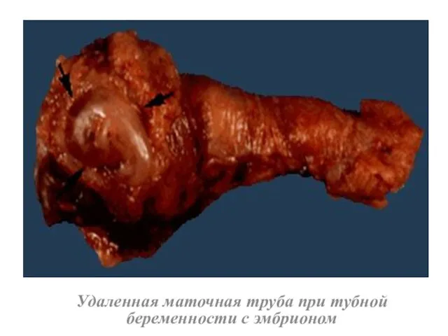 Удаленная маточная труба при тубной беременности с эмбрионом
